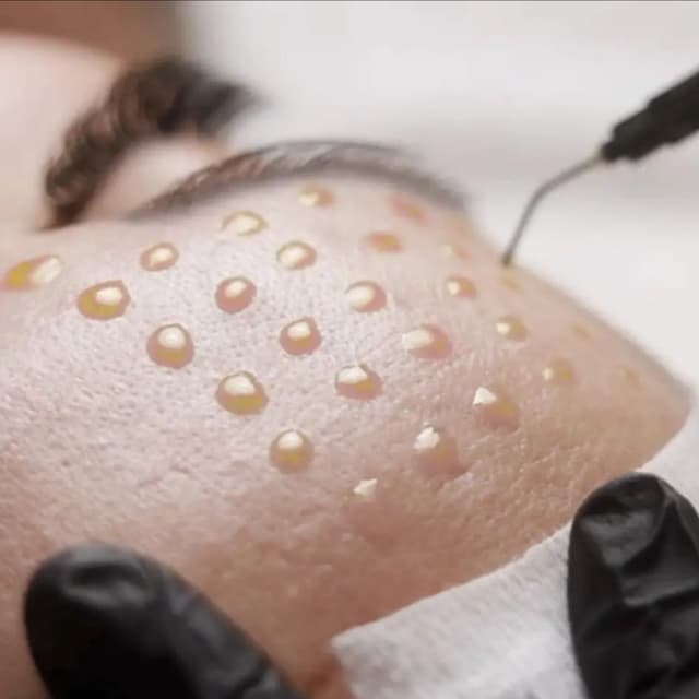 FactorFive Peel Package of 3 at Skinology Aesthetics in West Caldwell, NJ