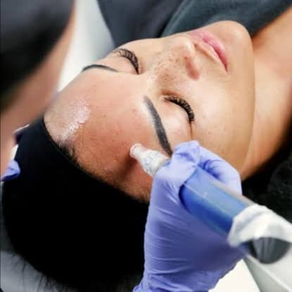 Microchanneling Package of 3 at Skinology Aesthetics in West Caldwell, NJ